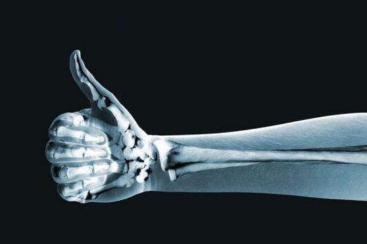 Rentgena starojums var palīdzēt diagnosticēt sāpes pirkstu locītavās