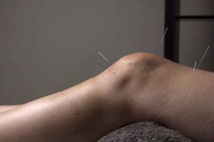 Akupunktūra veicina locītavu audu atjaunošanos