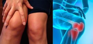 Diskomforts un pietūkums ceļa zonā ir pirmie artrozes simptomi