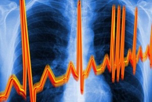Sirds ritma izmaiņas un traucējumi - dzemdes kakla osteohondrozes pazīme